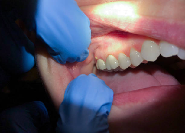 Best Broken or Chipped Tooth Repair in South Miami, FL